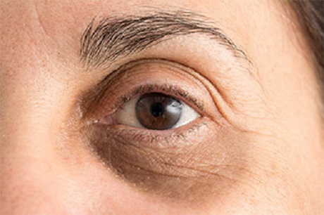 علت تیرگی دور چشم و رفع آن - اسکین مال
