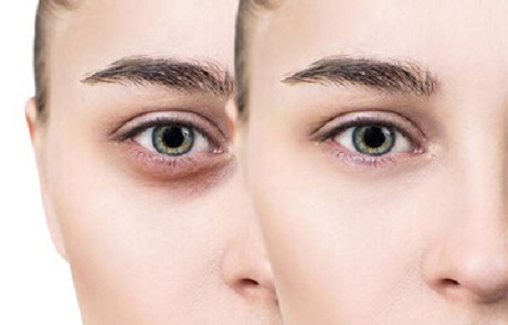 دلایل سیاهی زیر چشم - اسکین مال