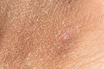 پوست دهیدراته - اسکین مال